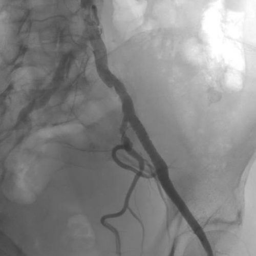 Angiographie Angiographie