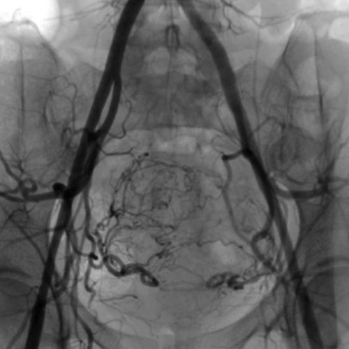 Embolisation fibrome Embolisation fibrome