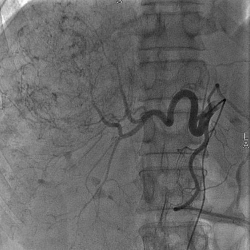 Embolisation hépatique Embolisation hépatique