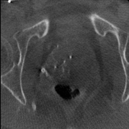 Embolisation prostate Embolisation prostate