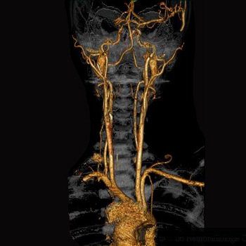 troncs_supra_aortiques1 troncs_supra_aortiques1